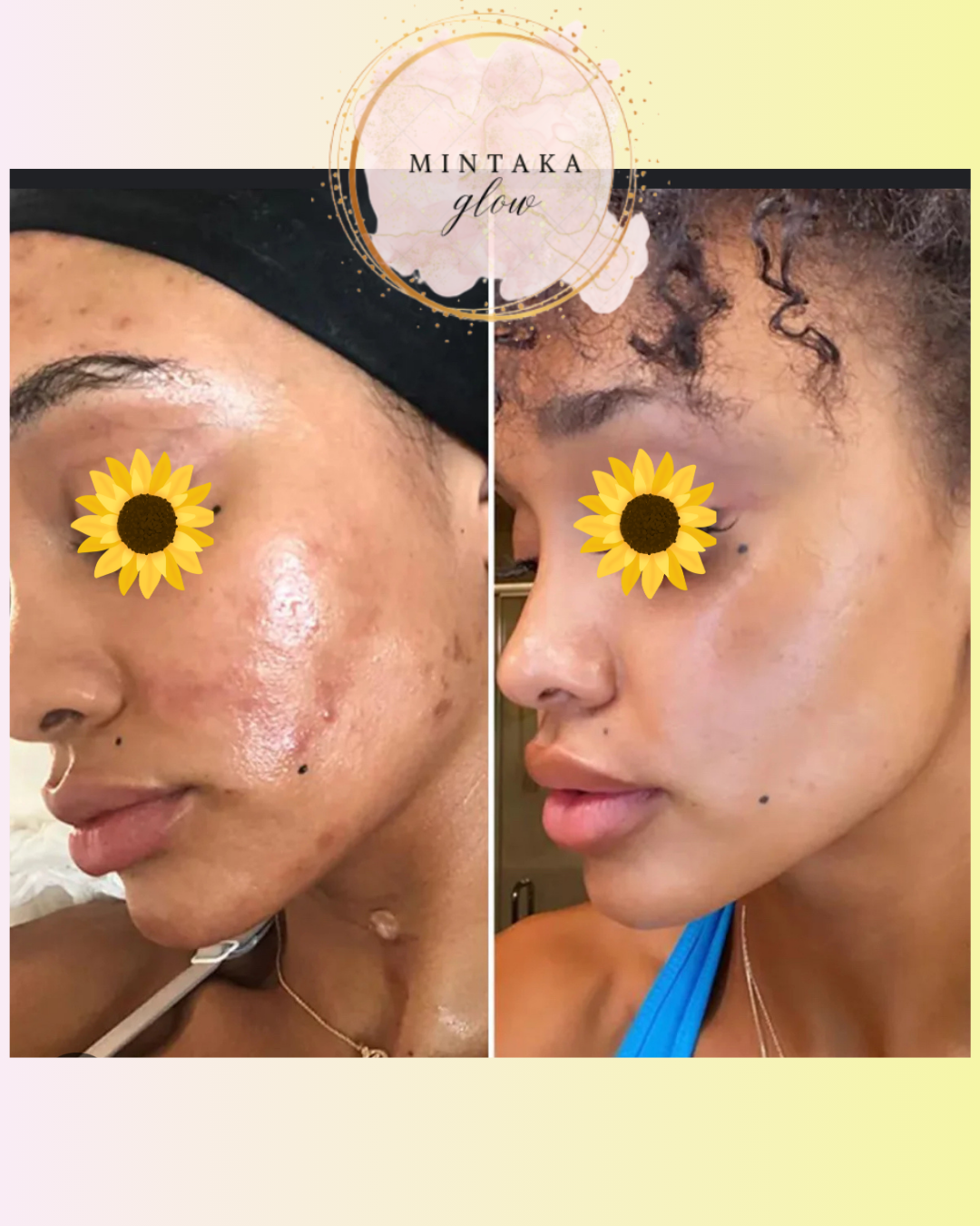 2Pcs Lemon Turmeric Kojic Acid Soap for Dark Spots